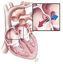 Atrial Septal Defect Heart Surgery in India