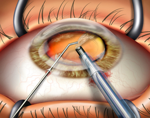 eye surgery benefits India