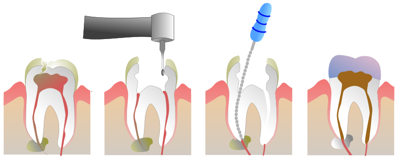 Root canals surgery India