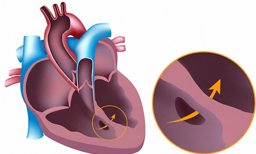 Top 15 Ventricular Septal Defect and VSD Closure Surgery Hospitals in India (2026-2027 Guide)