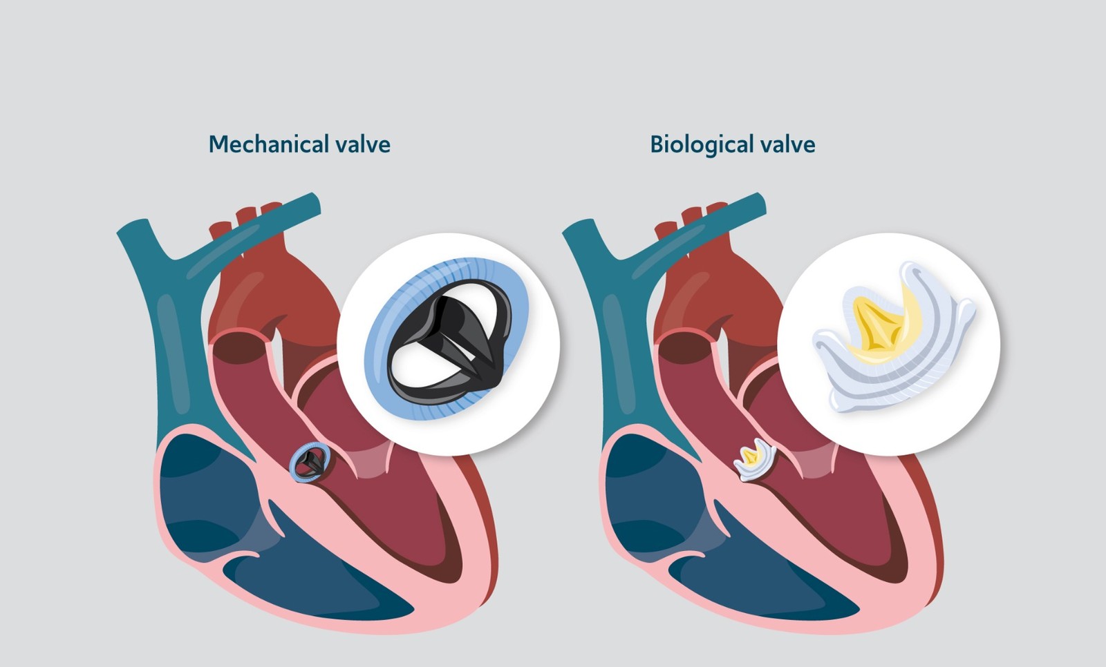 Top 15 Valve Replacement and Heart Valve Surgery Hospitals in India (2026-2027 Guide)