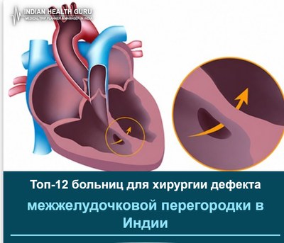 Топ-12 больниц для хирургии дефекта межжелудочковой перегородки в Индии (Руководство 2026-2027)
