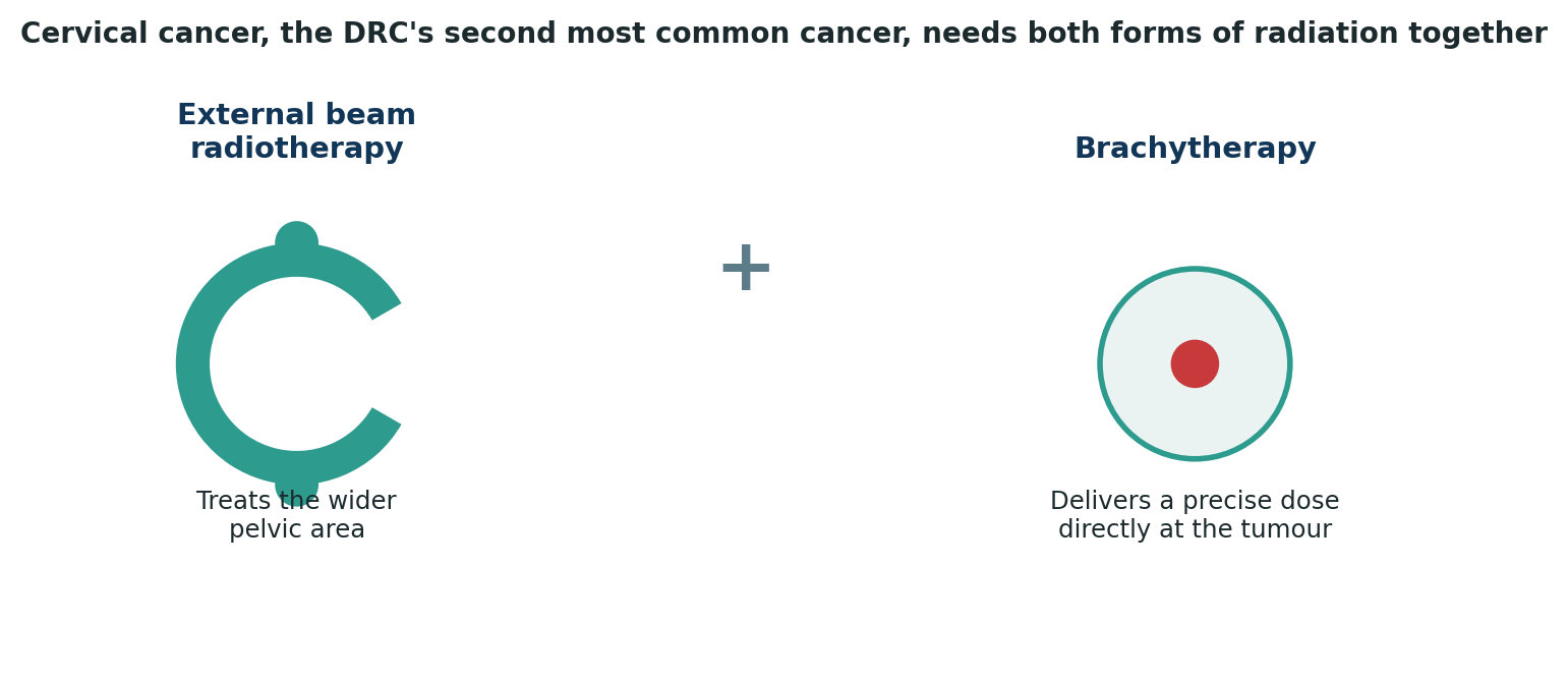 Chart: Cervical cancer treatment is not complete with just one form of radiation — the international standard requires both external beam therapy and brachytherapy working together