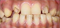 Dental Implantology, dental tooth implants, dental implants india, tooth replacement clinic mumbai