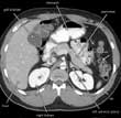 CT slice through the mid abdomen showing multiple normal appearing organs which are labeled.