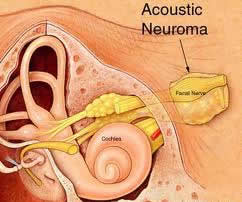 acoustic neuroma surgery India