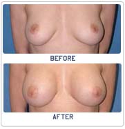 breast
