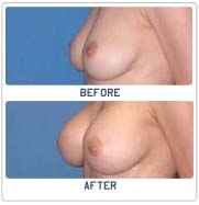 breast