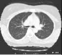 CT of the lungs, window level set to demonstrate the vessels and air ways - not intended to demonstrate the heart, spine muscles etc. This is used to look for things like pneumonia or lung cancer.