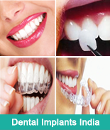 What's cost of Dental Implants in India