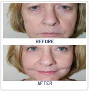 facelift