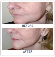 facelift