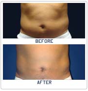 lipo