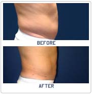lipo