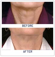 neck