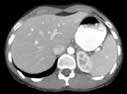 CT scan showing the liver.