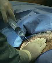 suction_inject