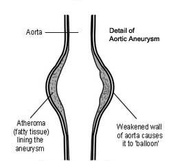Aortic Aneurysm surgery india