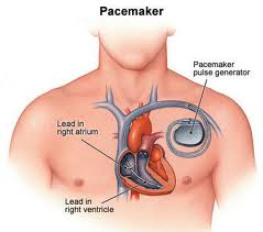 cardiac pacemakers India low cost benefits