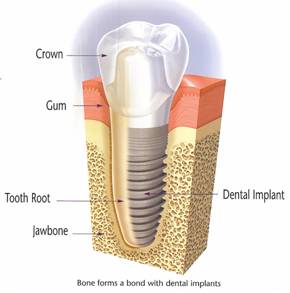 Dental Implants India Low Cost Benefits