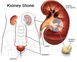 kidney stone surgery India