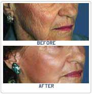 laser skin resurfacing surgery india