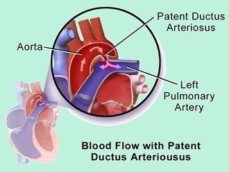 Patent Ductus Arteriosus Ligation surgery india