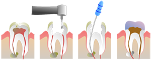 root canal surgery in india