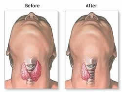 thyroidectomy surgery India low cost benefits