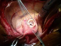 valve replacement surgery procedure India