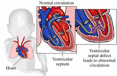 ventricular septal defect surgery India low cost benefits